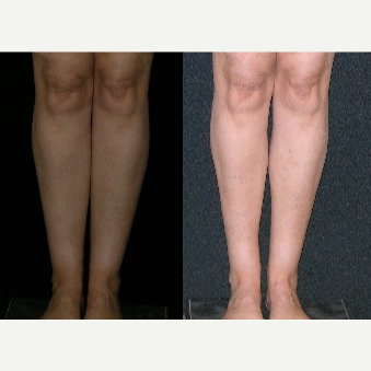 Liposuction of the Knees, Calves, and Ankles - Liposuction of the Knees, Calves, and Ankles