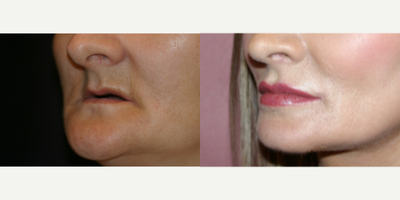 25-34 year old woman treated with Lip Augmentation - Working hand in hand with the dentist, her teeth were first reconstructed utilizing dental implants secured to her upper and lower jaw bones. Once performed, Dr. Randal Haworth carried out his signature FATMA operation to roll out her lip mucosa from the inside to the out while simultaneously performing a permanent fat transfer to her lips. To tie it all together, he also performed bilateral corner lip lifts.