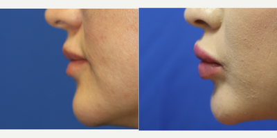 25-34 year old woman treated with Lip Implants - This patient in her mid-twenties desired plumper lips. She didn't want to return to the office every 8 months for lip fillers, so she opted for the Permalip permanent lip implant. The procedure took around 30 minutes and she now has the perfect pout.