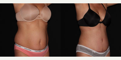 Tummy Tuck - Tummy Tuck