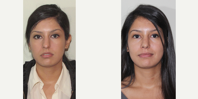 25-34 year old woman treated with Sinus Surgery - Female patient 3 months out from fractured nose and septum repair, turbinate reduction and septoplasty surgery.