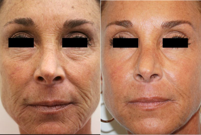 55-64 year old woman treated with Laser Resurfacing - SmartSkin CO2 Laser Resurfacing 2 month post 1 treatment for reduction of fine lines and wrinkles, improved texture and improved tone.