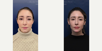 25-34 year old woman treated with Volbella, Vollure, Juvederm, Restylane Refyne, Restylane - A woman in her 30s, after the injection of filler into her chin and lips.