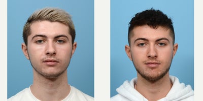 18-24 year old man treated with Chin Implant - Chin implant