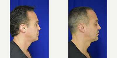 35-44 year old man treated with Revision Rhinoplasty - This patient had a previous rhinoplasty by a general plastic surgeon several years prior. He presented with impressive deformity of the nasal cartilages and collapse of the bridge and tip of the nose. In addition there was severe alar retraction and retraction of the collumella. Revision rhinoplasty was performed to build up the bridge and reposition the tip. The deformed cartilages were straightened and repositioned using specialized surture techniques and cartilage reinforcement grafts. The nostrils were revised to correct the retraction that had occured. The collumella was also grafted to replace the cartilage that had been removed. At 2 months out there is still swelling evident throughout the tip region. This is expected to settle over the next several months and improved tip definition will be realized.