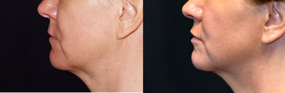 45-54 year old woman treated with Lip Implants - 46 year old female received a lip augmentation with PermaLip implant; photos depict the patient's results 3 months post-op.