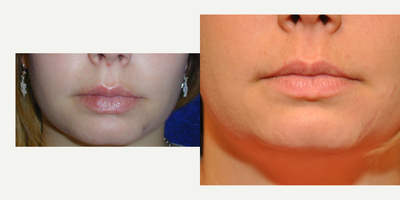 25-34 year old woman treated with Scar Removal - 26 year old female underwent scar revision surgery under local anesthesia.