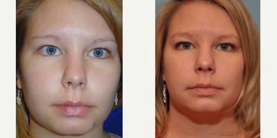 25-34 year old woman treated with Scar Removal - 26 year old female underwent scar revision surgery under local anesthesia.