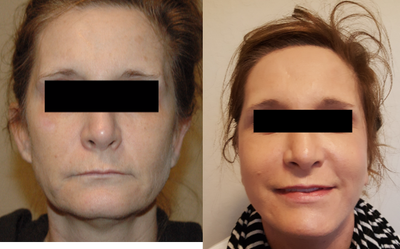 45-54 year old woman treated with Laser Resurfacing - 1 month after Smartskin Co2 resurfacing skin treatment for rejuvenation and reversing aging of skin as well as skin tightening at our office for wrinkles and skin aging. Of note she did have a face lift elsewhere.