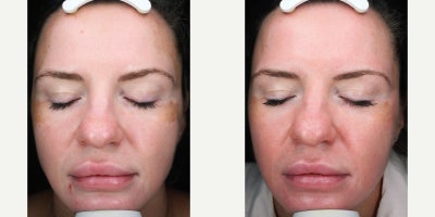 25-34 year old woman treated with Moxi - 1 MOXI Laser Treatment