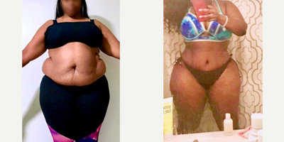 25-34 year old woman treated with Tummy Tuck, Liposuction, Brazilian Butt Lift - Excellent outcome after full tummy tuck combined with intense liposuction including abdomen, waist, laterals and upper and lower back to improve your body contour and get better curves, especially in your waist area and dominican butt lift.