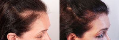 Woman treated with Nutrafol - Woman treated with Nutrafol