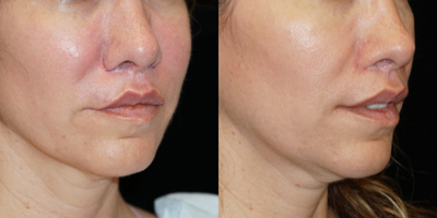 35-44 year old woman treated with Lip Repositioning - This patient came to me after she was unhappy from her previous lip lift. She was looking to have her upper teeth show slightly at rest, and she didnt like how her original lip lift did not address the lateral upper lip (this is very common). I performed a modified upper lip lift to address her concerns and give her the look she desired.