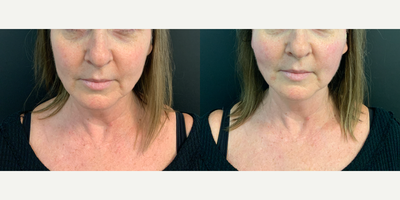 45-54 year old woman treated with NovaThreads - Lower Face Novathreads