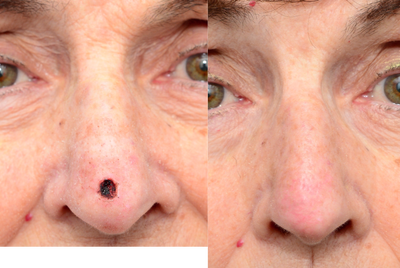 75 and up year old woman treated with Mohs Surgery - It is often said that Collaboration yields the finest results. This is most clearly evident when the reconstructive expertise of South Shore Plastic & Reconstructive Surgery is combined with the precision Mohs technique of Mariwalla Dermatology&nbsp;to produce incredible results! Here, we see a patient diagnosed with skin cancer, who underwent Mohs resection of a basal cell carcinoma on her nose by Dr. Kavita Mariwalla, of Mariwalla Dermatology, immediately followed by reconstruction of the resulting defect by Dr. Jonathan Landon, Chief of Plastic Surgery at South Shore Plastic & Reconstructive Surgery. Only ONE MONTH LATER, the patient has virtually no signs any surgery was performed at all! Best of all, she is now CURED OF CANCER.
