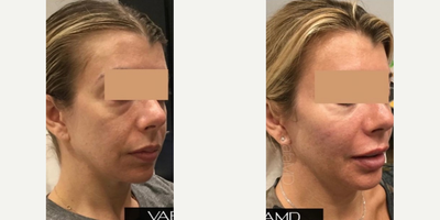 Woman treated with Sculptra - Woman treated with Sculptra