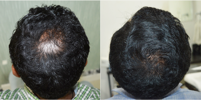 25-34 year old man treated with Derma Roller - 30 years old male patient with androgenetic alopecia[male pattern baldness]. 3 sessions of derma roller in 4 months done for the scalp. He was under minoxidil and topical hair care medicines.