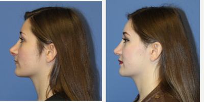 18-24 year old woman treated with Revision Rhinoplasty - Patient had surgery with an outside physician. She was very unhappy with the result and requested a revision. Dr. Bitner performed a revision rhinoplasty.