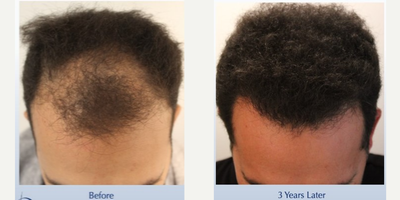 Bring My Big Curly Hair Back! (2312 FUT grafts) - This 39-year-old man underwent a follicular unit transplantation (FUT) session with Dr. Carlos K. Wesley in which a total of 2312 grafts were placed.  Aspects of our surgical approach can be viewed on our sites Most Common Questions page. Three unique elements combined to help improve his experience: no-shave requirement for optimal discretion, enhanced graft storage measures, and rigid patient safety standards. As with all of Dr. Wesleys patients, he was NOT required to cut his hair for the procedure.  As a result, this patient was able to return comfortably to work and social activities within approximately 7-10 days of his procedure.The patients hair follicles were incubated in platelet rich plasma (PRP) throughout the duration of the procedure.  This, combined with an ATP-containing storage solution has been shown to enhance survival of transplanted hairs.Finally, having his procedure performed in our office with the highest standards of COVID precautions helped ensure patient safety. Every patient of Dr. Wesleys receives a rapid COVID test upon arrival to our office equipped with an ultraviolet air purification system.  Measures such as reducing foot traffic by performing virtual consultations at no charge to patients, regular staff COVID testing and no-touch temperature checks of our team that avoids public transportation help preserve our clean and sanitary safe haven. Daily sterilization of the office coupled with the most rigid OR safety precautions further allay patient concerns in this sensitive time.   The patient returned 3 years after his procedure and images of the patient can be seen below.  This link illustrates the timing of hair growth after surgery.  Similar patient hair transformations with Dr. Wesley and his team may also be viewed.