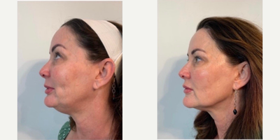 45-54 year old woman treated with Jet Peel - The result after one JetPeel Infusion Facial. JetPeel works wonders and addresses puffiness/water retention in the jawline/neck/under the eyes due to the lymphatic step as part of the treatment.