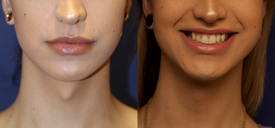 Patient treated with Adam's Apple Reduction - Patient treated with Adam's Apple Reduction