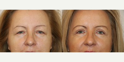 55-64 year old woman treated with Eyelid Surgery - This patient underwent a typical upper eyelid blepharoplasty. This is a gratifying procedure that takes one hour to complete. The recovery is not painful. The result is natural and very rejuvenating.