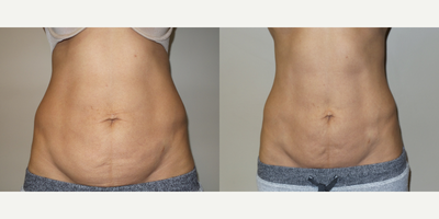 36 year old woman treated with Profound RF - 36 year old female treated with Profound RF to abdomen.