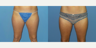 Woman treated with BodyTite - Woman treated with BodyTite