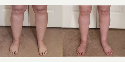35-44 year old woman treated with Lipedema Surgery, Liposuction on Calf and Ankle - This lovely patient was treated circumferentially with one surgery to her calf and ankle cosmetic unit.