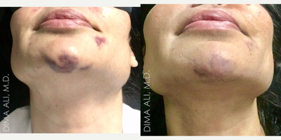 45-54 year old woman treated with Vbeam - 1 Day post VBeam Bruise treatment