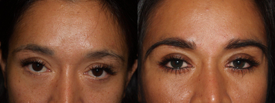 Before, Immediately After, and 1 Year After Eyebrow Transplant Procedure - Procedure Details: Patient from Australia, who desired maximum fullness of her genetically thin eyebrows. Because of the thickness of her donor hairs, these type of procedures can be challenging, yet by meticulously placing each graft in just the ideal direction, a natural and full result was achieved.
