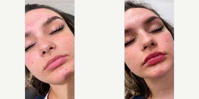 Woman treated with Restylane Kysse - Woman treated with Restylane Kysse as lip fillers