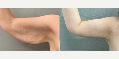 45-54 year old woman treated with Arm Lift - 51 y/o woman who under went an arm lift (brachioplasty) in our office O.R.