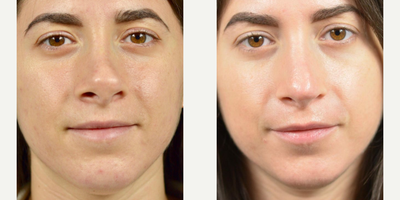 Woman treated with Revision Rhinoplasty - Here is an example of revision rhinoplasty. After 2 failed rhinoplasty surgeries with another surgeon years ago, this patient had been living with a nasal deformity and breathing issues. Dr. Marotta was able to restore symmetry and breathing function with a well planned out surgery and great skill.The anatomy of the nose is very complex. When done right, a rhinoplasty procedure can greatly enhance the appearance and function of the nose. Its known to be one of the most challenging plastic surgery procedures. When seeking out a surgeon to care for your most prominent facial feature, its so important to consider the experience of the surgeon.