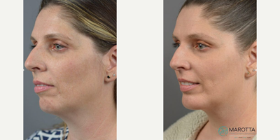 Woman treated with Chin Implant, Chin Liposuction - Our patient came to us with the goal of making her profile more symmetrical. Dr. Marotta gave her just that with a chin implant, sub mental liposuction and most importantly, a new sense of confidence.