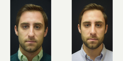 25-34 year old man treated with Septoplasty and Rhinoplasty - 25-34 year old man treated with Septoplasty and Rhinoplasty