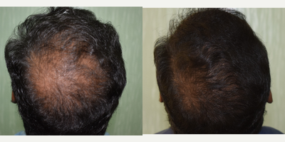 25-34 year old man treated with Derma Roller - 27 Years old male with androgenetic alopecia. 4 sessions of derma roller for scalp done with topical hair care solutions.