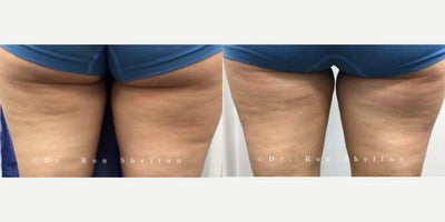 55-64 year old woman treated with Aveli - This impressive result came from just one Avli treatment targeting the marked dimples. The results are typically long-lasting, and no additional treatments are expected.