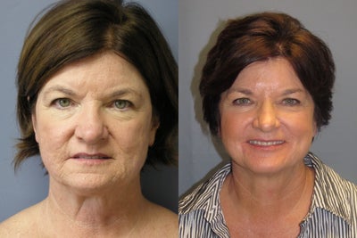 LiteLift, Blepharoplasty, Temple Brow Lift on 62-year-old Woman - This 62-year-old woman had a
LiteLift&trade;, a Blepharoplasty and a Temple Brow Lift. &nbsp;Notice her refined jaw line and skin texture.