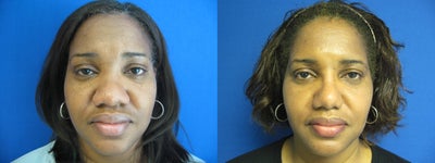 49 Year Old Treated for Nasal Reshaping - 49 Year old AA female treated with Rib cartilage graft and alar reduction to improve flat middle nose and wide nostrils. 2 month post-op photos.