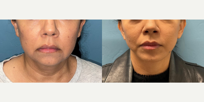 46 year old woman treated with Facelift, SMAS Facelift, Lower Facelift - This is a young 46 year old patient who came to us unhappy with her jowls and jaw line. After completing a SMAS face lift, her neck is tighter and her jowls are improved. She also has a more refined jaw line.