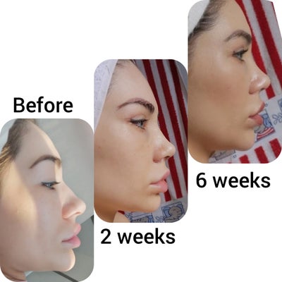 I Love My Rhinoplasty Eye Lid Surgery With Dr Serkan Balta