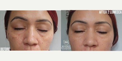 25-34 year old woman treated with IPL - Lumecca IPL: Saying Goodbye to Sun Damage & PigmentationProvider: Beverly Wilshire AestheticsTreatment: Lumecca IPL (Intense Pulsed Light)Protocol: 2 SessionsThe TransformationThis patient came to us looking to address years of sun damage and stubborn hyperpigmentation concentrated on the cheeks and bridge of the nose. After just two sessions of Lumecca, the highest-powered IPL on the market, the difference is clear.Why Lumecca?Unlike standard IPL treatments that can require 4-6 sessions for significant results, Lumecca uses a higher peak power to target pigment more effectively. In this After photo, you can see: Significant fading of dark spots and freckles. A more even, radiant skin tone. Improved overall skin clarity and brightness.What to Expect The Sensation: Often described as a light rubber band snap against the skin. The Coffee Ground Effect: After treatment, pigmented spots will darken (looking like coffee grounds) before naturally flaking off within 710 days, revealing fresh, clear skin underneath. Downtime: Minimal to none. Patients can typically apply makeup and return to their routine immediately. Expert Tip: To maintain these results, daily SPF is non-negotiable! Protecting your new skin from UV rays prevents old pigment from returning and new spots from forming.