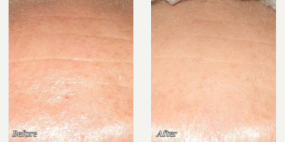Woman treated with Morpheus8 - Woman treated with Morpheus8