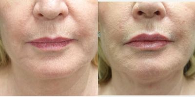 55-64 year old woman treated with Fat Transfer for her Lip Augmentation - The patient underwent 4cc of fat transfer for her upper and lower lip augmentation. Fat transfer is a longer lasting treatment option for women that are tired of getting lip fillers every six months. The pictures show her results at two months.