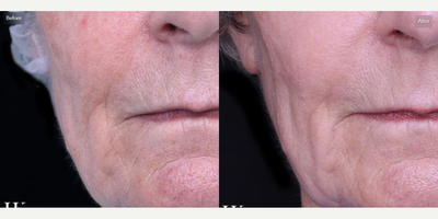 Woman treated with ActiveFX, Botox, DeepFX - Woman treated with ActiveFX, Botox, DeepFX