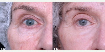 Woman treated with ActiveFX, Botox, DeepFX - Woman treated with ActiveFX, Botox, DeepFX
