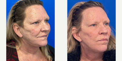 55-64 year old woman treated with CO2 Laser - 57 year old patient treated with 2 sessions of CO2 laser skin resurfacing.