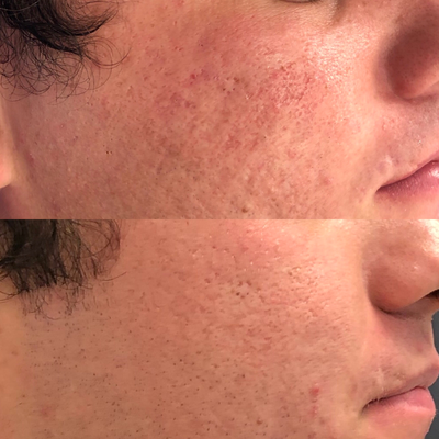 18-24 year old man treated with Vivace - Vivace