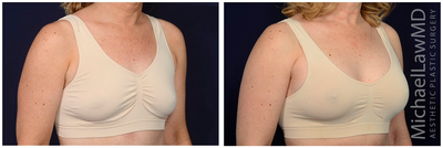 45-54 year old woman treated with Ideal Implant - Breast augmentation. Follow-up photos taken 8 months after the procedure.